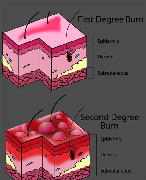 Third <b>degree</b> <b>burns</b> usually require a skin graft. . Is a second degree burn osha recordable